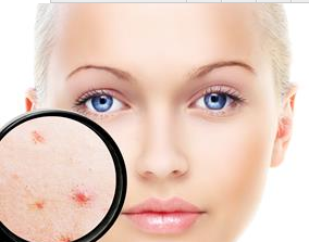 如何徹底地告別痤瘡？試試這些方法