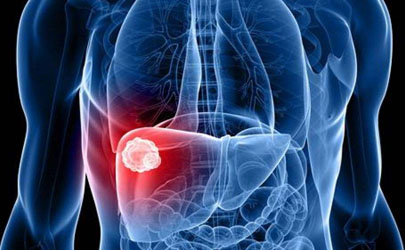 脂肪肝患者可以吃肉不 有脂肪肝的人吃什么菜