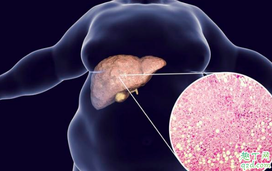 烏龍茶能讓脂肪肝患者喝嗎 什么茶葉對脂肪肝好2