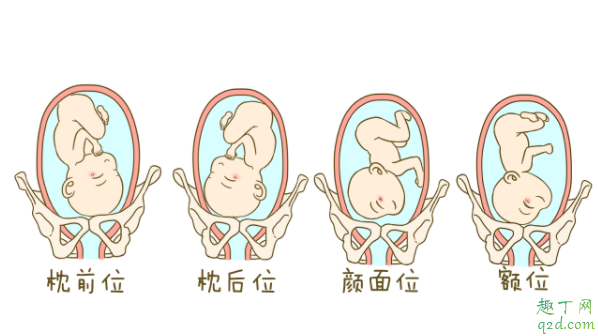 懷孕七個月寶寶臀位怎么糾正 單胎臀位不能順產(chǎn)嗎3