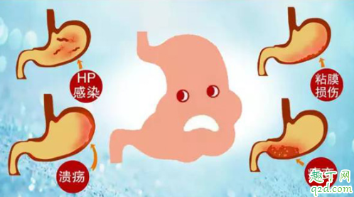 胃癌是不是必須開(kāi)刀 胃癌癥會(huì)不會(huì)傳染2