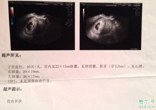 有卵黃囊就一定會有胎心胎芽嗎 卵黃囊什么時(shí)候能看到3