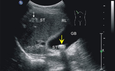 孕36周胎兒顯示頭偏小怎么辦 羊水少了吃什么可以補(bǔ)