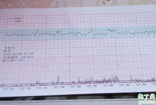 懷孕后沒有看到胎心胎芽怎么回事 懷孕多長(zhǎng)時(shí)間用胎心監(jiān)護(hù)器3